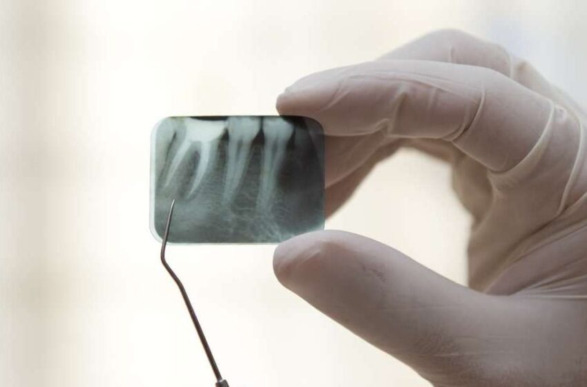 Osteoporose pode fazer os dentes caírem depois dos 40 anos