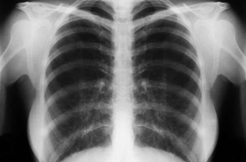 Pneumonia pode provocar tosse, febre e dificuldades para respirar e até levar à morte