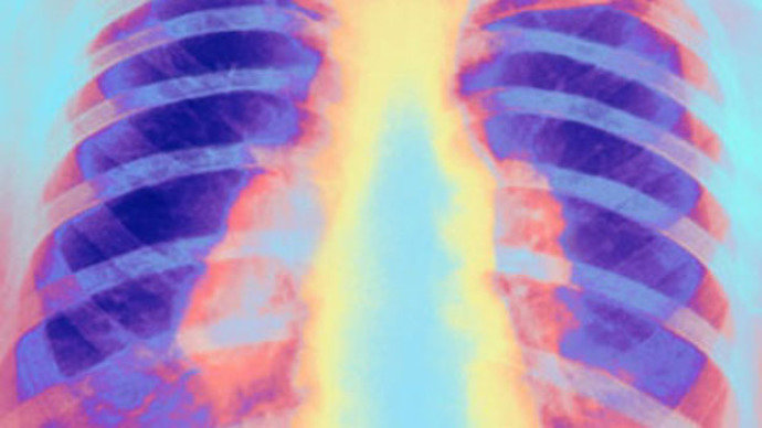 Terapia genética traz resultados promissores contra fibrose cística