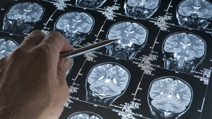 Pesquisadores veem sinais de progresso em tratamento para Alzheimer